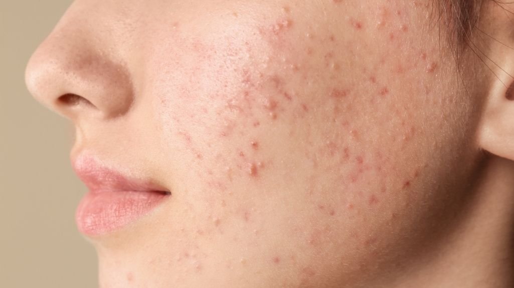 Why Choose Korean Skincare for Acne Scars?