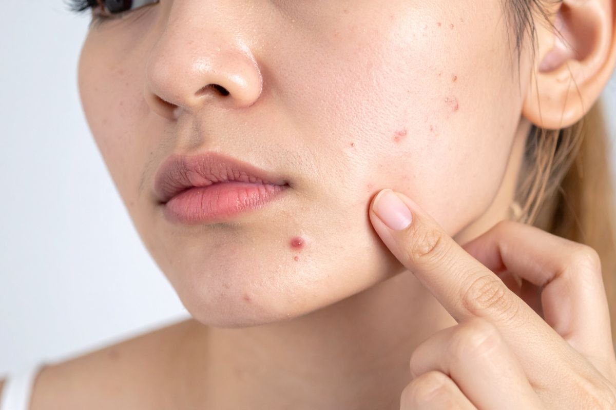 Korean acne treatment NZ